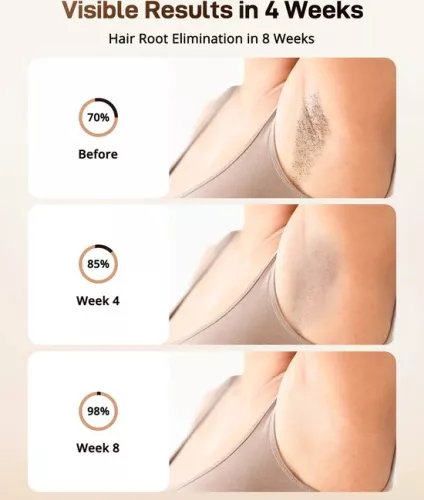 merkloos Hair Removal Device - Laser Hair Removal - Hair Removal - Men and Women - Full Body - Long Lasting Hair Removal (6151011331356)